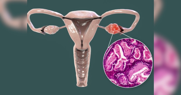 1 lakh cases of ovarian cancer in India every year AIIMS found a way to keep patients alive for longer | भारत में हर साल आ रहे ओवेरियन कैंसर के 1 लाख केस, एम्स ने खोजा मरीजों को ज्यादा दिनों तक जिंदा रखने का उपाय