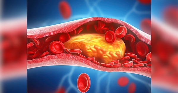 ldl cholesterol will be removed from veins without medicine start drink this juice as soon as symptoms appear | बिना दवा नसों से निकल जाएगा गंदा कोलेस्ट्रॉल, लक्षण दिखते ही पीना शुरू कर दें ये जूस