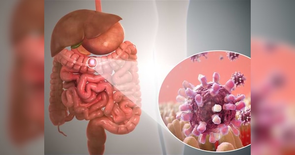 risk of gastrointestinal cancer is higher in men get tested fast after symptoms appear | महिलाओं से ज्यादा पुरुषों में गैस्ट्रोइंटेस्टाइनल कैंसर का खतरा, डॉक्टर की सलाह ये लक्षण दिखते ही तुरंत करवा लें जांच